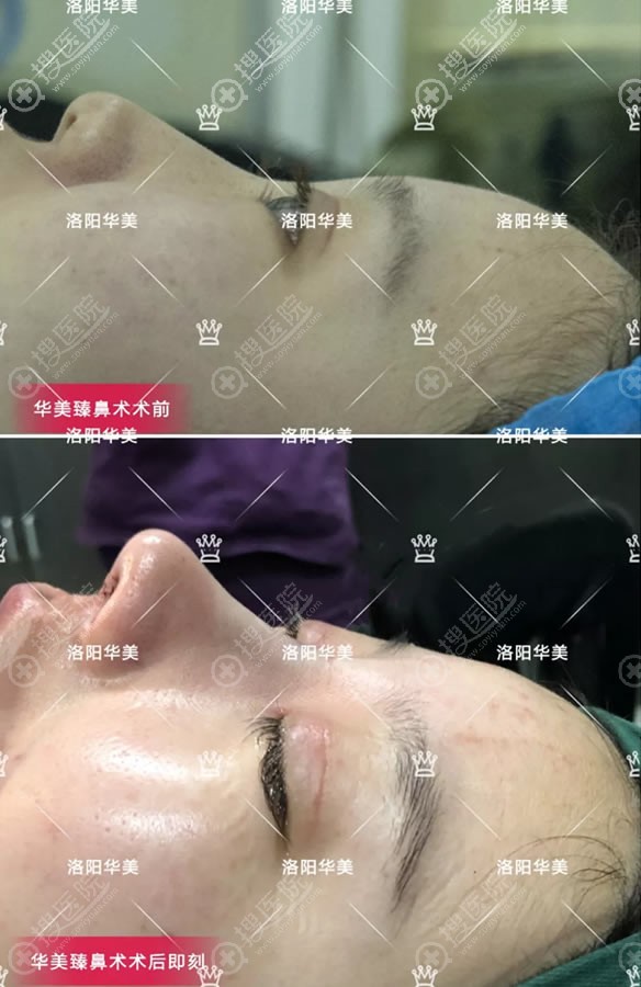 洛阳华美自体软骨鼻综合案例即刻效果 洛阳华美自体软骨鼻综合案例即刻效果