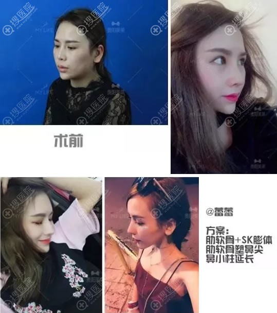 贵阳美莱刘照肋软骨鼻综合案例 贵阳美莱刘照肋软骨鼻综合案例