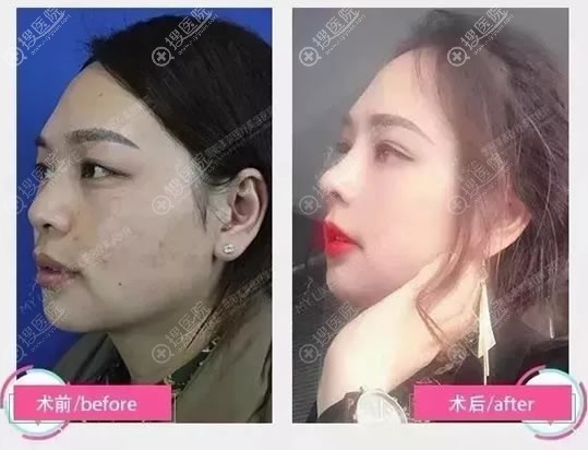 贵阳美莱梁洁院长达拉斯隆鼻案例 贵阳美莱梁洁院长达拉斯隆鼻案例