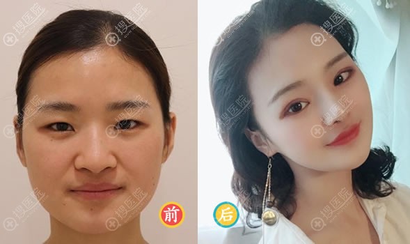 韩国纯真崔宰源埋线双眼皮案例 韩国纯真崔宰源埋线双眼皮案例