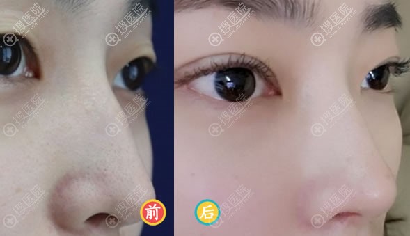 韩国纯真整形崔宰源鼻综合案例 韩国纯真整形崔宰源鼻综合案例