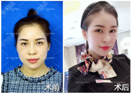 南宁梦想整形医院超皮秒祛斑案例对比图 南宁梦想整形医院超皮秒祛斑案例对比图