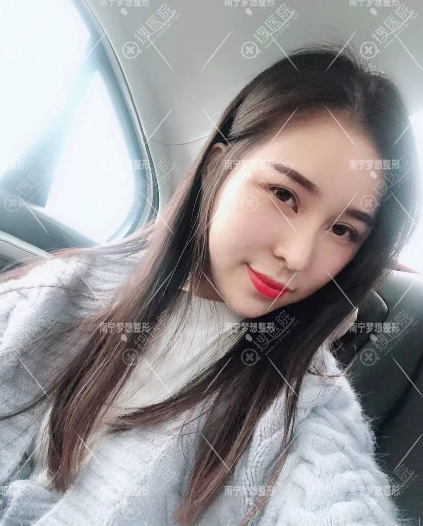 南宁梦想整形医院超皮秒祛斑真人案例 南宁梦想整形医院超皮秒祛斑真人案例