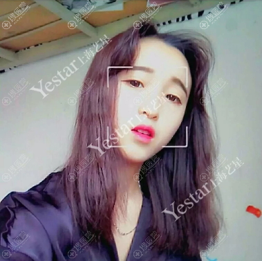 在<!--<i data=20240710 data-id=12757></i>-->做隆鼻手术前 在<!--<i data=20240710 data-id=12757></i>-->做隆鼻手术前