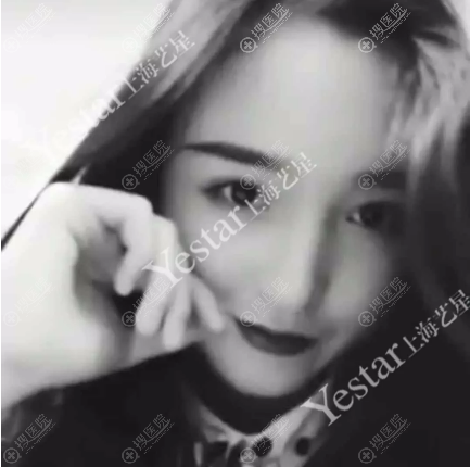 在上海yestar做完隆鼻一个月了 在上海yestar做完隆鼻一个月了