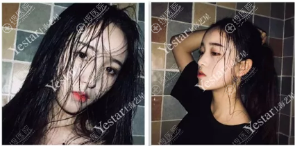 <!--<i data=20240710 data-id=12757></i>-->李建兵做的隆鼻案例 <!--<i data=20240710 data-id=12757></i>-->李建兵做的隆鼻案例