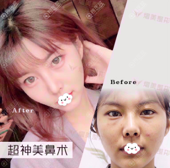 <!--<i data=20240710 data-id=10957></i>-->杨孟根“超神美鼻术”隆鼻整形真人案例 <!--<i data=20240710 data-id=10957></i>-->杨孟根“超神美鼻术”隆鼻整形真人案例