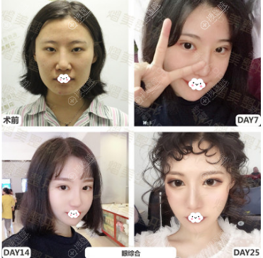 <!--<i data=20240710 data-id=10957></i>-->割双眼皮效果怎么样?参考徐赞正眼综合整形案例 <!--<i data=20240710 data-id=10957></i>-->割双眼皮效果怎么样?参考徐赞正眼综合整形案例