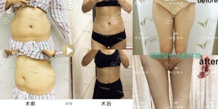 <!--<i data=20240710 data-id=10957></i>-->吸脂腰腹、吸脂瘦大腿真人案例 <!--<i data=20240710 data-id=10957></i>-->吸脂腰腹、吸脂瘦大腿真人案例