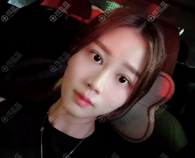 福州海峡林秀兰做的双眼皮案例 福州海峡林秀兰做的双眼皮案例