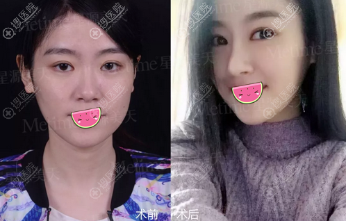塌鼻子变挺拔 分享我在石家庄星源美天做综合隆鼻的真实经历