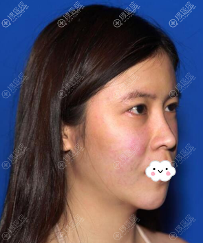 找<!--<i data=20240710 data-id=14413></i>-->医院刘兵割双眼皮+肋骨隆鼻整形真人案例 找<!--<i data=20240710 data-id=14413></i>-->医院刘兵割双眼皮+肋骨隆鼻整形真人案例