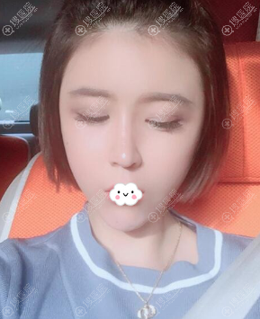 <!--<i data=20240710 data-id=14413></i>-->医院双眼皮+肋骨隆鼻整形术后效果 <!--<i data=20240710 data-id=14413></i>-->医院双眼皮+肋骨隆鼻整形术后效果