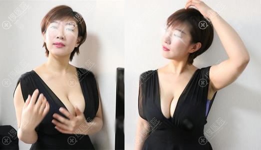 <!--<i data=20240710 data-id=14083></i>-->赵宏伟假体隆胸案例半年效果 <!--<i data=20240710 data-id=14083></i>-->赵宏伟假体隆胸案例半年效果