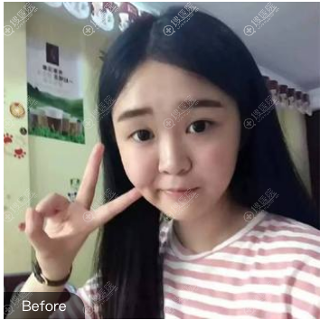 ��˫��Ƥ�޸���ǰ��Ƭ