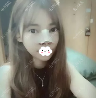 呼和浩特大韩整形假体+鼻翼鼻头缩小+鼻小柱延长综合隆鼻案例
