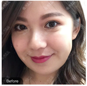 看了西安高一生的溶脂案例后找西安美莱王鹏做了面部吸脂瘦脸