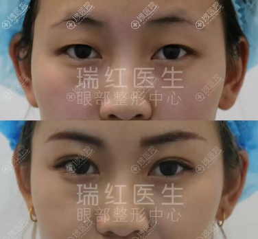 新疆乌鲁木齐医瑞整形<!--<i data=20240710 data-id=16654></i>-->韩式芭比翘睫双眼皮案例 新疆乌鲁木齐医瑞整形<!--<i data=20240710 data-id=16654></i>-->韩式芭比翘睫双眼皮案例
