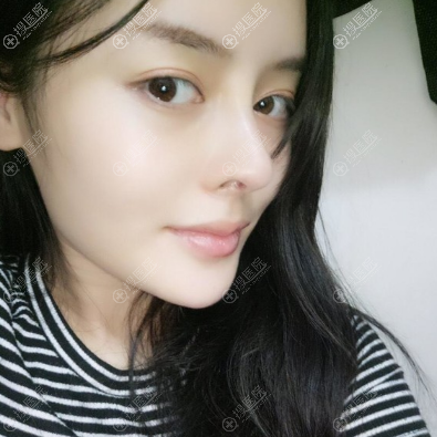耳软骨鼻综合隆鼻术后15天 耳软骨鼻综合隆鼻术后15天