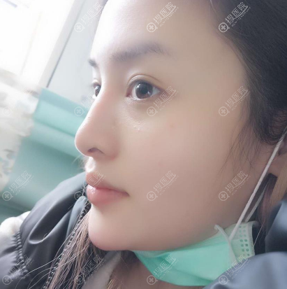 我找上海华晋孙建斌做的双眼皮和隆鼻子,感觉技术好价格也合理