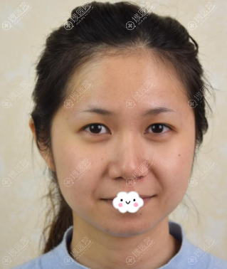 <!--<i data=20240710 data-id=8348></i>-->整形医院割双眼皮真人案例 <!--<i data=20240710 data-id=8348></i>-->整形医院割双眼皮真人案例