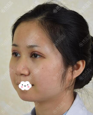<!--<i data=20240710 data-id=8348></i>-->整形医院双眼皮+开眼角术后效果 <!--<i data=20240710 data-id=8348></i>-->整形医院双眼皮+开眼角术后效果