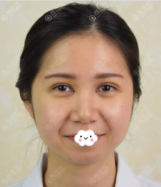 广州割双眼皮哪家好?<!--<i data=20240710 data-id=8348></i>-->整形眼综合案例 广州割双眼皮哪家好?<!--<i data=20240710 data-id=8348></i>-->整形眼综合案例