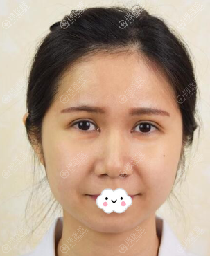 <!--<i data=20240710 data-id=8348></i>-->双眼皮效果怎么样?眼综合术后16天恢复图 <!--<i data=20240710 data-id=8348></i>-->双眼皮效果怎么样?眼综合术后16天恢复图