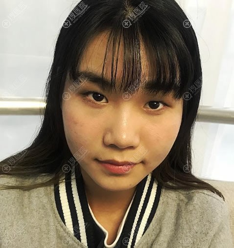 无意中找到北京炫美割双眼皮的价格表就去找周亮做了埋线双眼皮