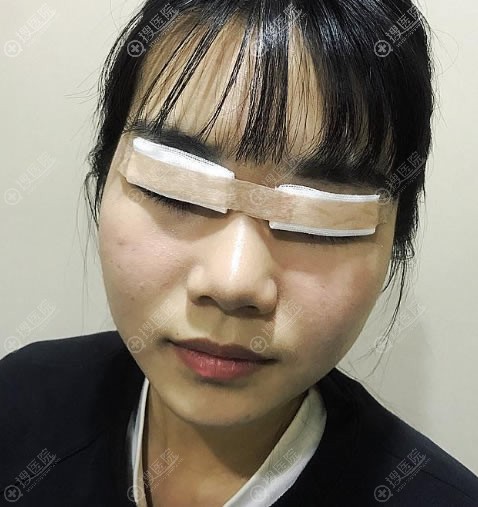 <!--<i data=20240710 data-id=12618></i>-->刚做完双眼皮手术图片 <!--<i data=20240710 data-id=12618></i>-->刚做完双眼皮手术图片