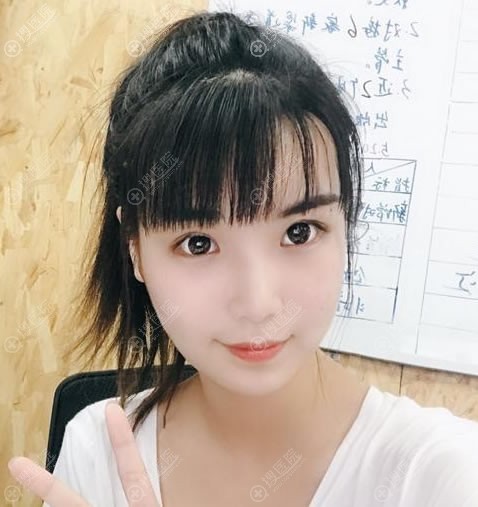<!--<i data=20240710 data-id=12618></i>-->周亮双眼皮案例10天效果 <!--<i data=20240710 data-id=12618></i>-->周亮双眼皮案例10天效果
