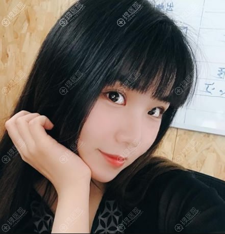 <!--<i data=20240710 data-id=12618></i>-->整形周亮双眼皮案例30天效果 <!--<i data=20240710 data-id=12618></i>-->整形周亮双眼皮案例30天效果