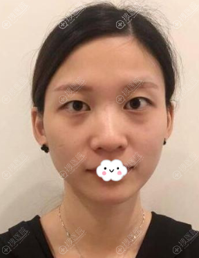 <!--<i data=20240710 data-id=12584></i>-->黄富伟双眼皮+开眼角真人案例 <!--<i data=20240710 data-id=12584></i>-->黄富伟双眼皮+开眼角真人案例