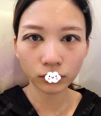 <!--<i data=20240710 data-id=12584></i>-->黄富伟双眼皮+开眼角术后效果 <!--<i data=20240710 data-id=12584></i>-->黄富伟双眼皮+开眼角术后效果