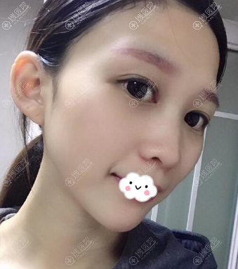 四川<!--<i data=20240710 data-id=12584></i>-->整形医院黄富伟双眼皮效果好吗 四川<!--<i data=20240710 data-id=12584></i>-->整形医院黄富伟双眼皮效果好吗