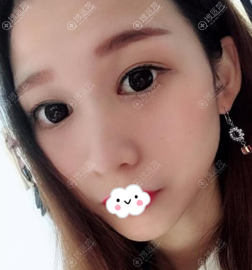 四川割双眼皮哪家医院好?<!--<i data=20240710 data-id=12584></i>-->黄富伟案例效果图 四川割双眼皮哪家医院好?<!--<i data=20240710 data-id=12584></i>-->黄富伟案例效果图