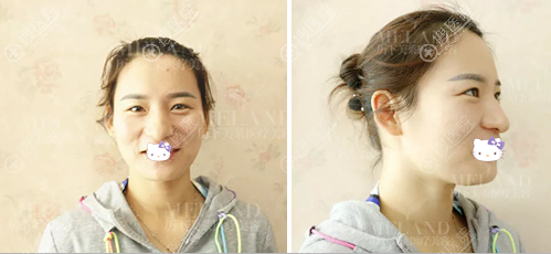 济南美莲韩旭隆鼻+面部脂肪填充让大鼻缩小后的宝妈燃起热情