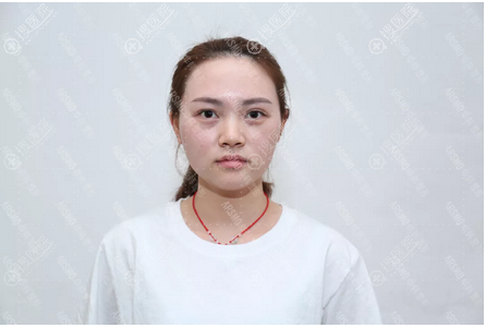分享我去长沙华韩华美找张涛医生做隆鼻和自体脂肪填充的经历