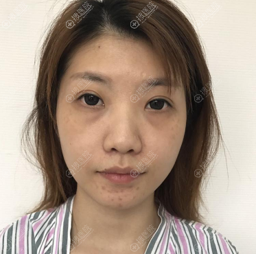 再三对比后我选择上海余天成冯焕做双眼皮提肌无力修复和隆鼻