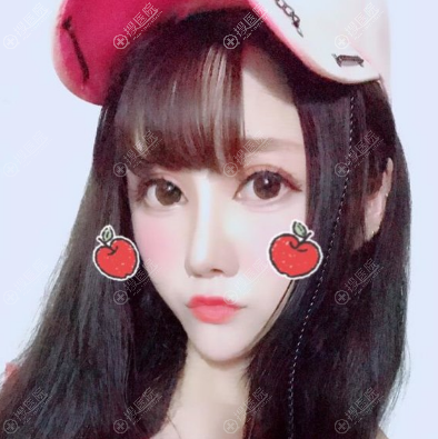 <!--<i data=20240710 data-id=14020></i>-->冯焕做的双眼皮修复和隆鼻案例图 <!--<i data=20240710 data-id=14020></i>-->冯焕做的双眼皮修复和隆鼻案例图