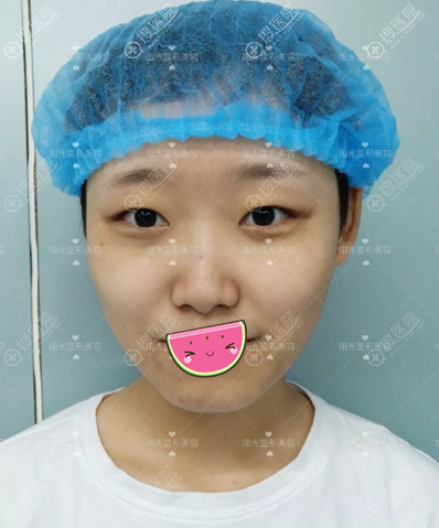 在郑州阳光整形做双眼皮3个月我又找杨小顺做了假体隆鼻垫下巴