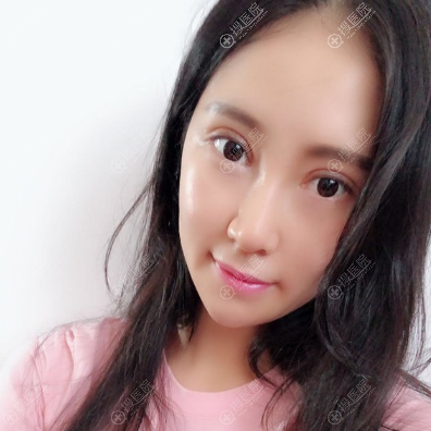 <!--<i data=20240710 data-id=11218></i>-->吸雕双眼皮隆鼻案例恢复照片 <!--<i data=20240710 data-id=11218></i>-->吸雕双眼皮隆鼻案例恢复照片