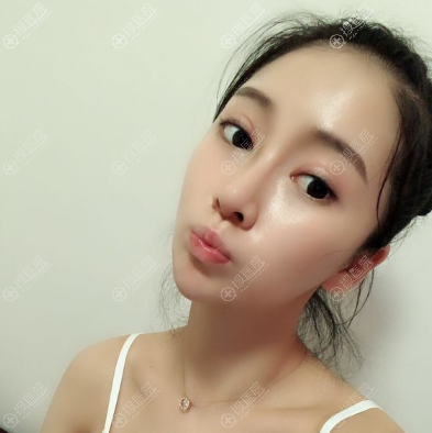 <!--<i data=20240710 data-id=11218></i>-->整形医院吸雕双眼皮案例 <!--<i data=20240710 data-id=11218></i>-->整形医院吸雕双眼皮案例