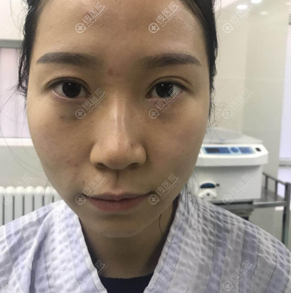 双眼皮隆鼻术前照片 双眼皮隆鼻术前照片