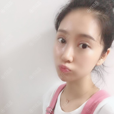 <!--<i data=20240710 data-id=11218></i>-->整形医院双眼皮隆鼻案例术后五天 <!--<i data=20240710 data-id=11218></i>-->整形医院双眼皮隆鼻案例术后五天