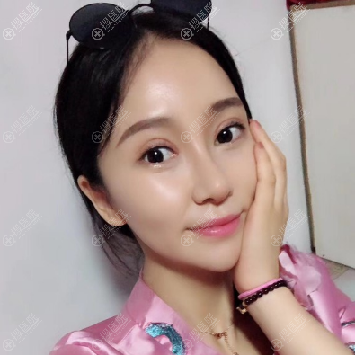 <!--<i data=20240710 data-id=11218></i>-->整形医院董涛做的双眼皮隆鼻案例 <!--<i data=20240710 data-id=11218></i>-->整形医院董涛做的双眼皮隆鼻案例