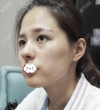 广州军美王世虎案例与价格助您了解广州哪家医院脂肪填充好?