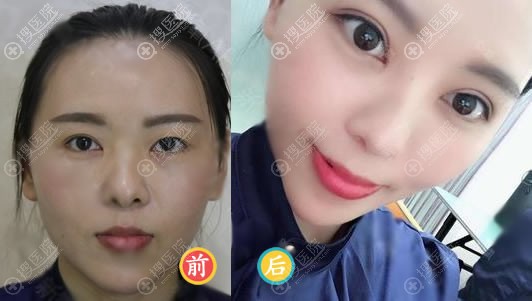 <!--<i data=20240710 data-id=12041></i>-->医美叶武锋双眼皮案例 <!--<i data=20240710 data-id=12041></i>-->医美叶武锋双眼皮案例
