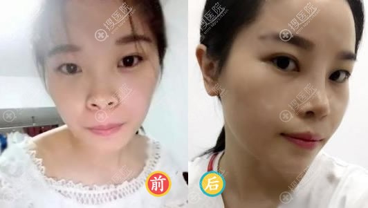 <!--<i data=20240710 data-id=12041></i>-->医美叶武锋隆鼻案例 <!--<i data=20240710 data-id=12041></i>-->医美叶武锋隆鼻案例