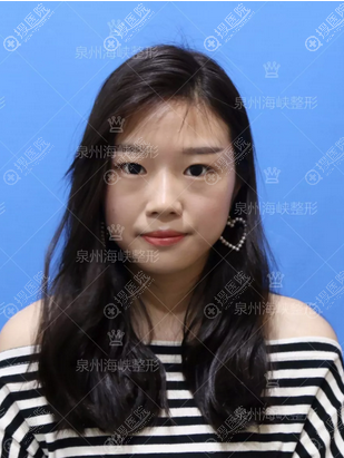 看了泉州海峡和华美的案例价格表后找郭永军做了全切双眼皮